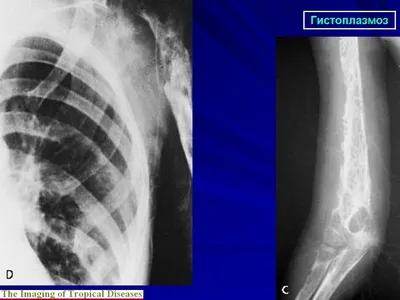 Мик. Гистоплазмоз. + | Портал радиологов