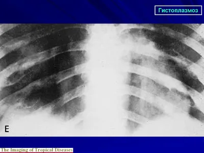 Мик. Гистоплазмоз. + | Портал радиологов