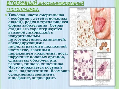 Гистоплазмоз - презентация онлайн