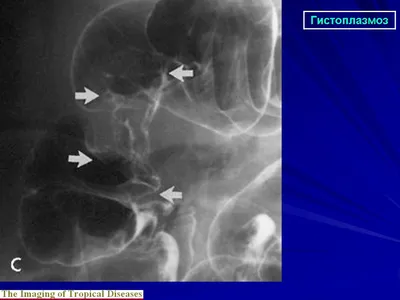 Мик. Гистоплазмоз. + | Портал радиологов