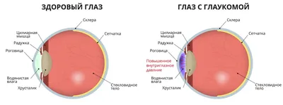 Глаукома: причина и симптомы, методы лечения и профилактики, виды и формы  заболевания