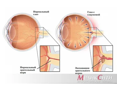 Глаукома: причины появления, симптомы, диагностика и лечение. Операция при  глаукоме