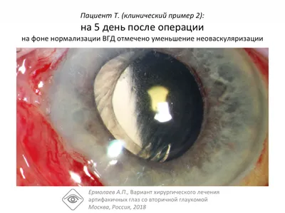 Заболевание глаз. Открытоугольная глаукома - Центр Хирургии Глаза
