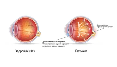 Вторичная глаукома на артифакичных глазах | Энциклопедия офтальмологии