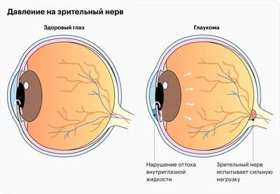 Глаукома . Что мы лечим. МНТК \"Микрохирургия глаза\"