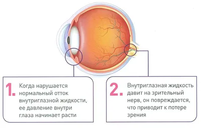Глаукома: провоцирующие факторы, симптомы, методы лечения -  Офтальмологические клиники «Эксимер» (Киев) – диагностика и лечение  заболеваний глаз у взрослых и детей