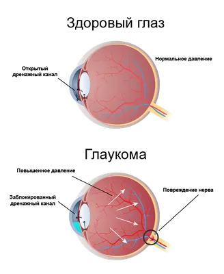 Глаукома — лечение в СПб, диагностика и профилактика глаукомы