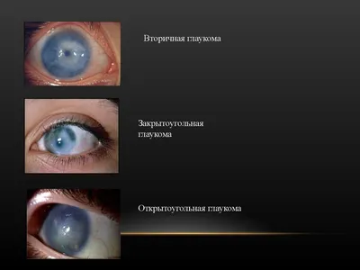 Почему возникает глаукома: причины, симптомы, формы и методы лечения -  энциклопедия Ochkov.net
