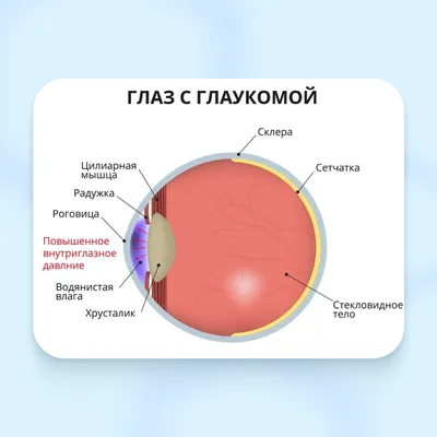 Заболевание глаз - глаукома - online presentation