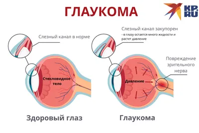 Симптомы глаукомы - Мой офтальмолог