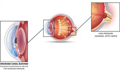 Симптомы глаукомы, причины и лечение