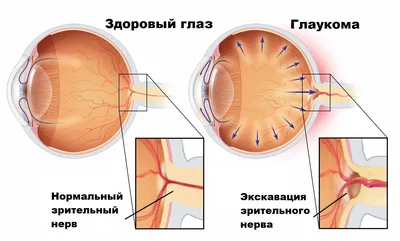 Оперативное лечение глаукомы глаза