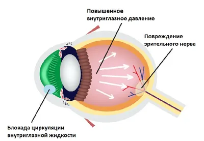Чем опасна глаукома? «Ochkov.net»