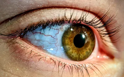 Незаметный убийца зрения: чем опасна глаукома и как ее лечат :: РБК Pro