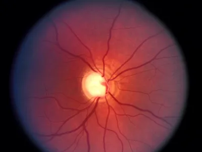 Хирургическое лечение глаукомы - Центр глазной хирургии