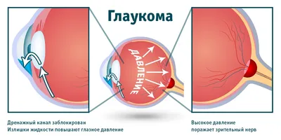 Глаукома – что это, симптомы, причины возникновения, виды, диагностика,  лечение и профилактика