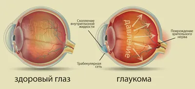 Глаукома - диагностика и лечение глаукомы в клинике Прозрение