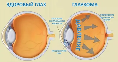 Лечение глаукомы медикаментозно, оперативно, лазером |Zrenie