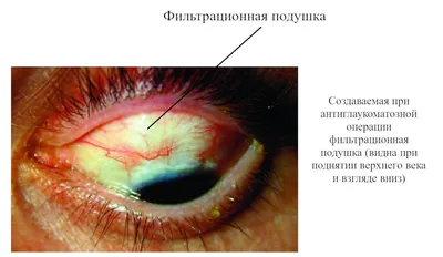 Глаукома - причины развития, симптомы, формы глаукомы, диагностика и  лечение.