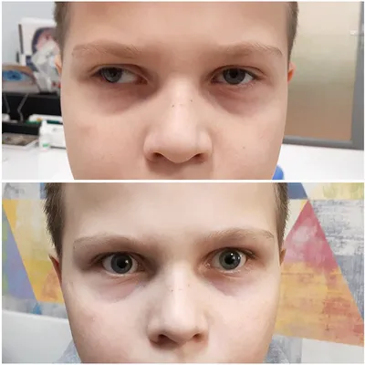 Глаз после операции на косоглазие фото фото