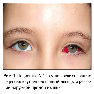 Лечение косоглазия у детей и взрослых. Эзотропия и экзотропия |  Интернет-журнал Estetmedicina.ru