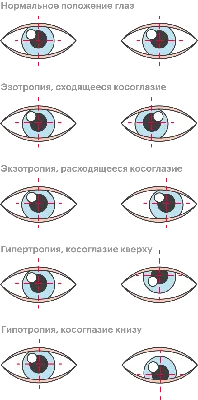 Косоглазие:Симптомы косоглазия,Причины возникновения косоглазия,Косоглазие  у детей | doc.ua