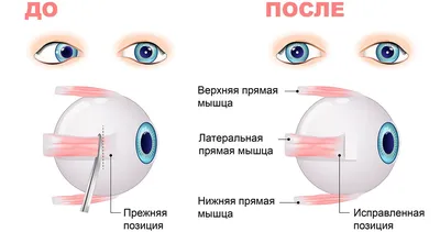 Реабилитация после операции по исправлению косоглазия - энциклопедия  Ochkov.net