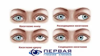 Что нужно знать о косоглазии? - Medpark