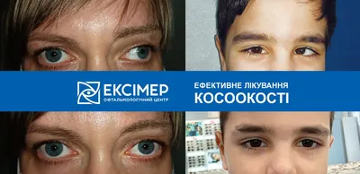 Офтальмологическая клиника «Смотри» - Косоглазие