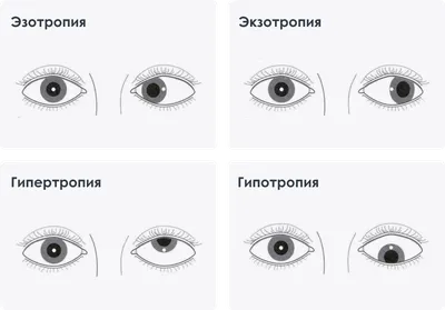 Рефракционные нарушения: симптомы дезадаптации и текущие заболевания -  Страница 3 из 7 - Издательство АПРЕЛЬ