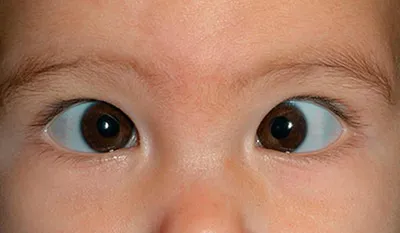 Причины и лечение двоения в глазах - Неврология проблемы