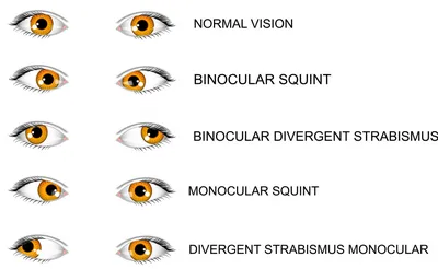 Allasia Казахстан - Лечение в Корее - Косоглазие — это нарушение положения  глаз, при котором выявляется отклонение одного или обоих глаз поочередно  при взгляде прямо. ⠀ ✓При симметричном положении глаз изображения предметов