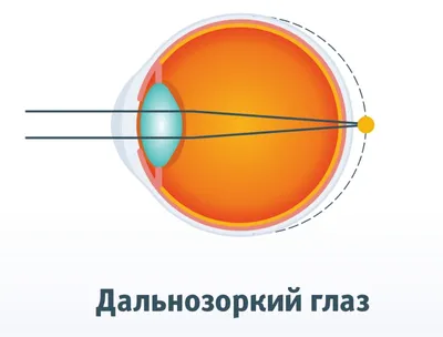 Лазерная коррекция пресбиопии