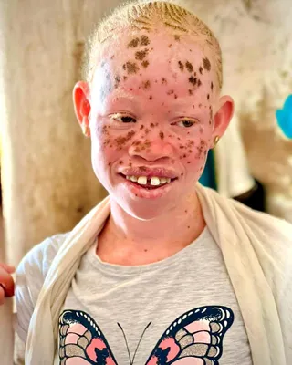 Фото: террористы взорвали глаз ребенка альбиносов Стоковое Фото -  изображение насчитывающей людск, малыш: 183198300