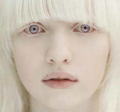 Почему у людей с альбинизмом часто бывает плохое зрение?