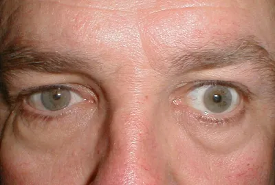 Глаза болезни фото фото