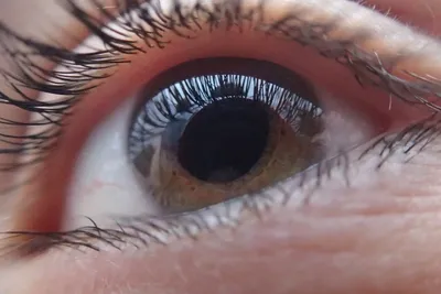 Офтальмолог Тахчиди перечислил болезни, о которых сигнализируют красные  глаза