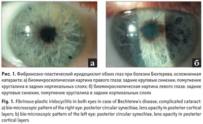 Красивые глаза\" как симптом болезни. | Пикабу