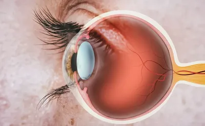 Рис. 1. Фибринозно-пластический иридоциклит обоих глаз при болезни Бех…