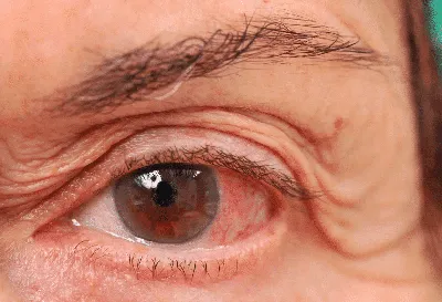 IPL М22 для лечения болезни сухого глаза - Premium Aesthetics