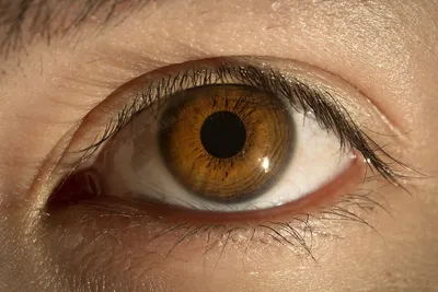 Красивые глаза\" как симптом болезни. | Пикабу
