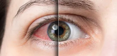 Глаза умеют говорить. Психосоматика болезни глаз.
