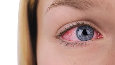 Почему у всех наркоманов красные глаза? | Обучение за границей + РФ Smapse  | Дзен
