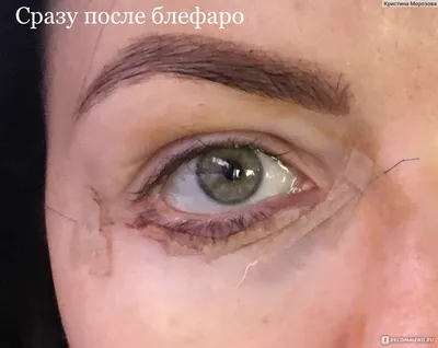 Круглый глаз после блефаропластики - YouTube
