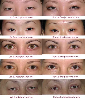 Простые правила по уходу за глазами после блефаропластики - Cosmetic-clinic