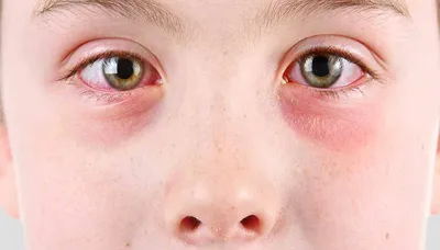 Глаза при аллергии фото фото
