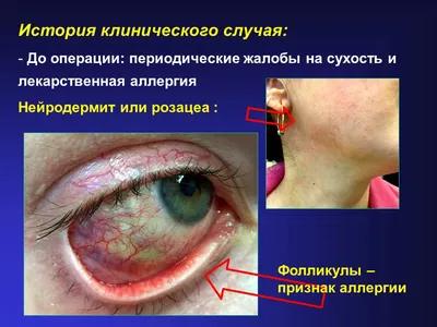 Аллергия – симптомы и профилактика – \"Жирновская центральная районная  больница\"