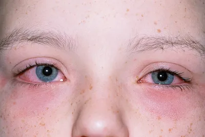 Капли для глаз от аллергии для детей и взрослых | Мегаптека