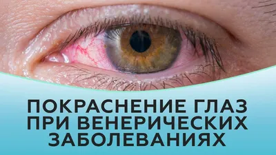 Покраснение глаз при венерических заболеваниях - YouTube