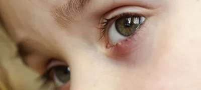 Ячмень на глазу у взрослых и детей: лечение, причины, стадии, признаки и  симптомы
